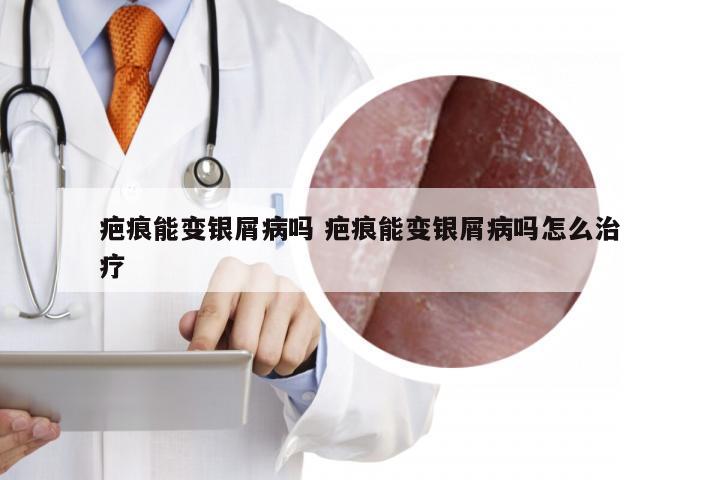 疤痕能变银屑病吗 疤痕能变银屑病吗怎么治疗