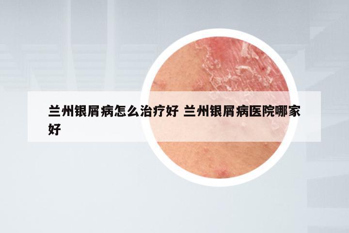 兰州银屑病怎么治疗好 兰州银屑病医院哪家好