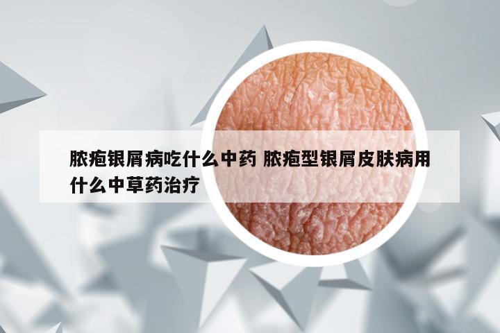 脓疱银屑病吃什么中药 脓疱型银屑皮肤病用什么中草药治疗