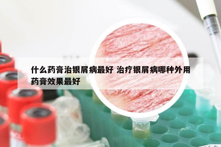 什么药膏治银屑病最好 治疗银屑病哪种外用药膏效果最好