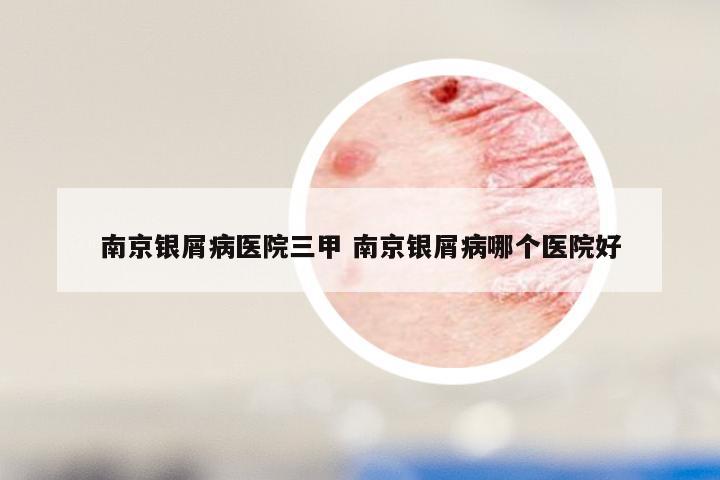 南京银屑病医院三甲 南京银屑病哪个医院好