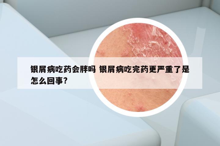 银屑病吃药会胖吗 银屑病吃完药更严重了是怎么回事?