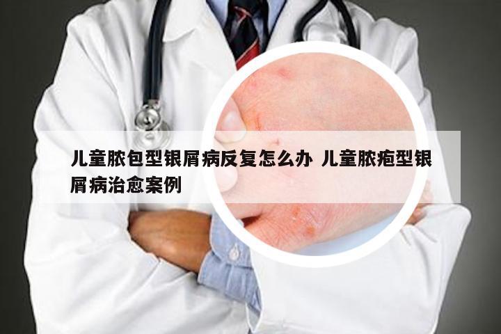 儿童脓包型银屑病反复怎么办 儿童脓疱型银屑病治愈案例