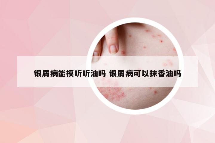 银屑病能摸听听油吗 银屑病可以抹香油吗