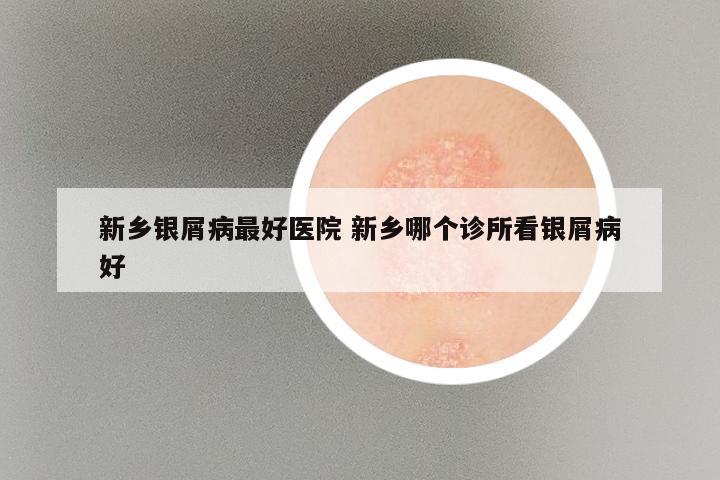 新乡银屑病最好医院 新乡哪个诊所看银屑病好