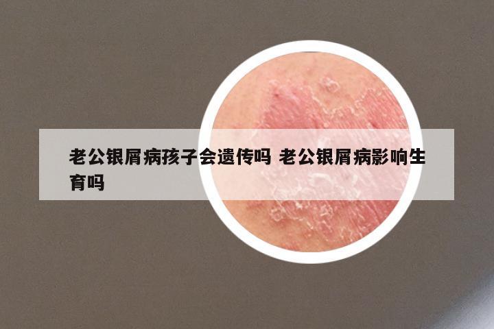 老公银屑病孩子会遗传吗 老公银屑病影响生育吗