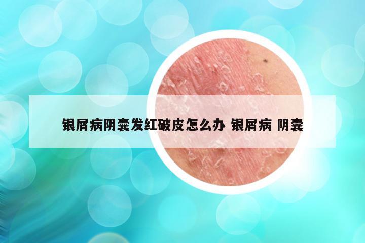 银屑病阴囊发红破皮怎么办 银屑病 阴囊