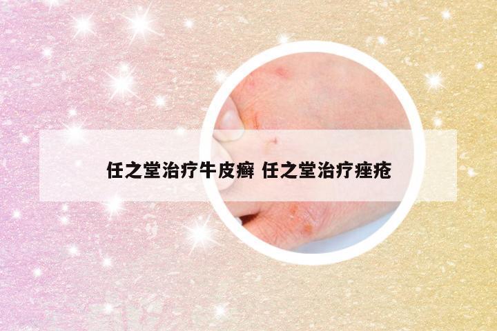 任之堂治疗牛皮癣 任之堂治疗痤疮