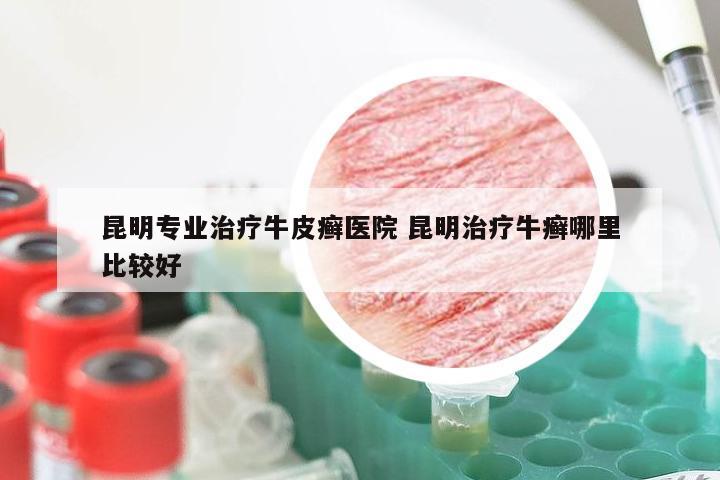 昆明专业治疗牛皮癣医院 昆明治疗牛癣哪里比较好