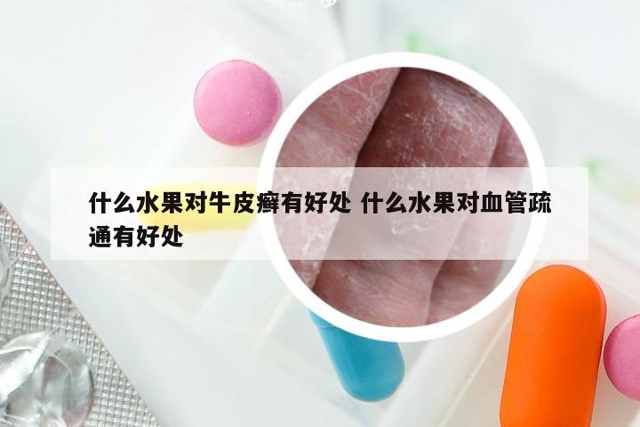 什么水果对牛皮癣有好处 什么水果对血管疏通有好处