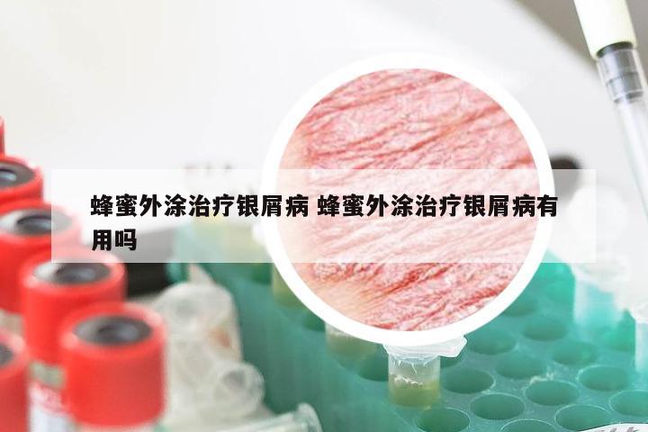 蜂蜜外涂治疗银屑病 蜂蜜外涂治疗银屑病有用吗