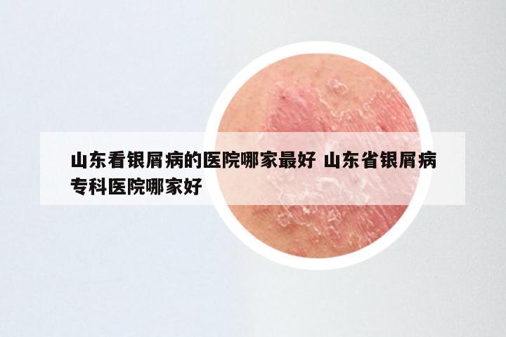 山东看银屑病的医院哪家最好 山东省银屑病专科医院哪家好