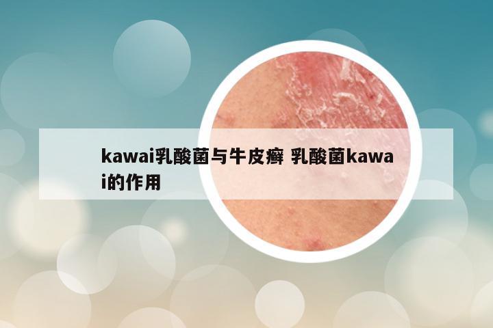 kawai乳酸菌与牛皮癣 乳酸菌kawai的作用