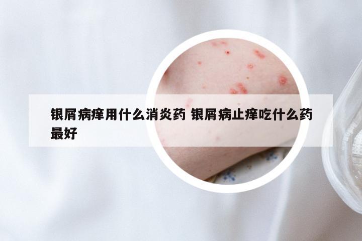 银屑病痒用什么消炎药 银屑病止痒吃什么药最好