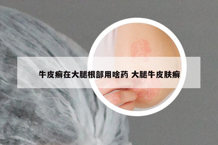 牛皮癣在大腿根部用啥药 大腿牛皮肤癣