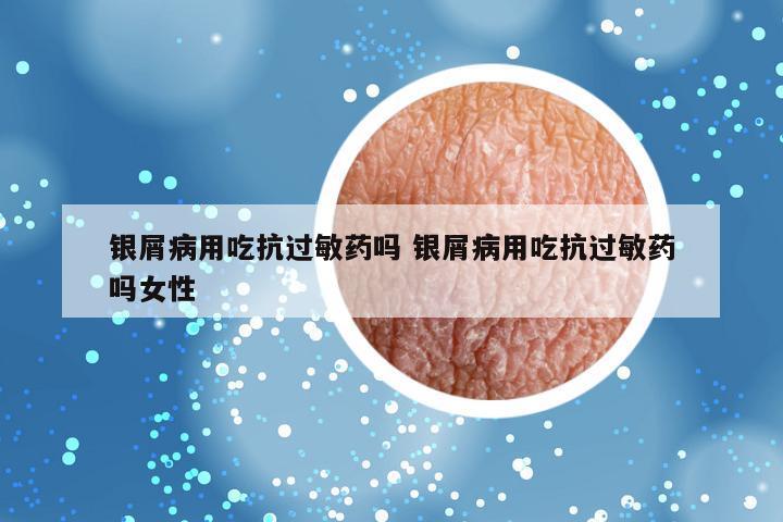 银屑病用吃抗过敏药吗 银屑病用吃抗过敏药吗女性