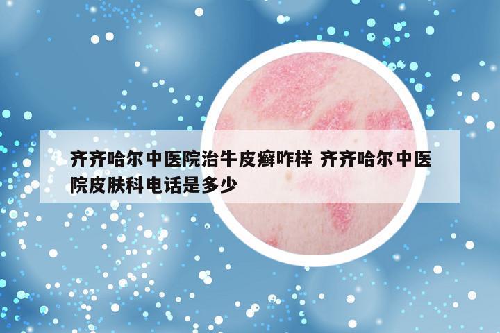 齐齐哈尔中医院治牛皮癣咋样 齐齐哈尔中医院皮肤科电话是多少