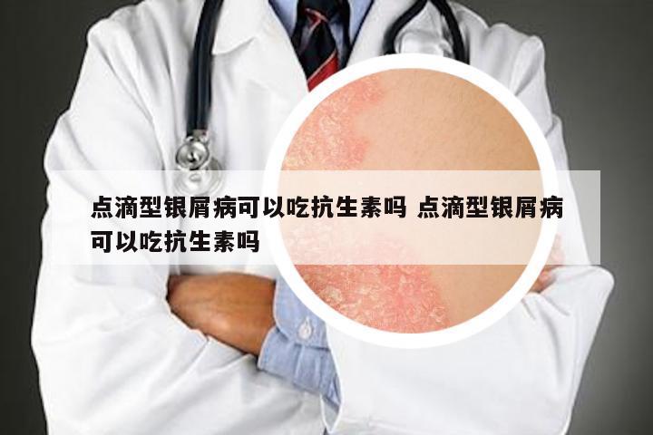 点滴型银屑病可以吃抗生素吗 点滴型银屑病可以吃抗生素吗