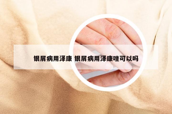 银屑病用泽康 银屑病用泽康唑可以吗