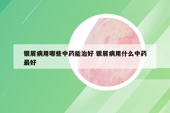 银屑病用哪些中药能治好 银屑病用什么中药最好