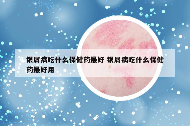 银屑病吃什么保健药最好 银屑病吃什么保健药最好用