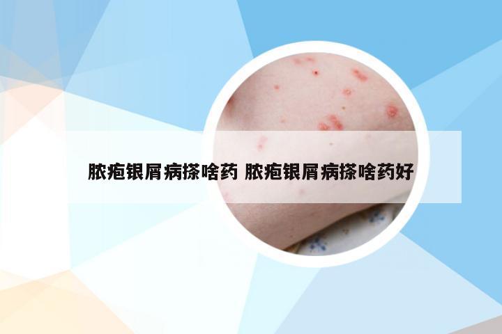 脓疱银屑病搽啥药 脓疱银屑病搽啥药好