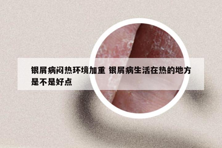 银屑病闷热环境加重 银屑病生活在热的地方是不是好点