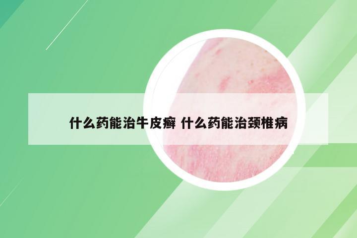 什么药能治牛皮癣 什么药能治颈椎病