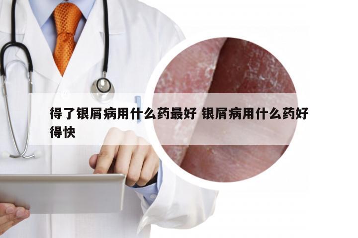 得了银屑病用什么药最好 银屑病用什么药好得快