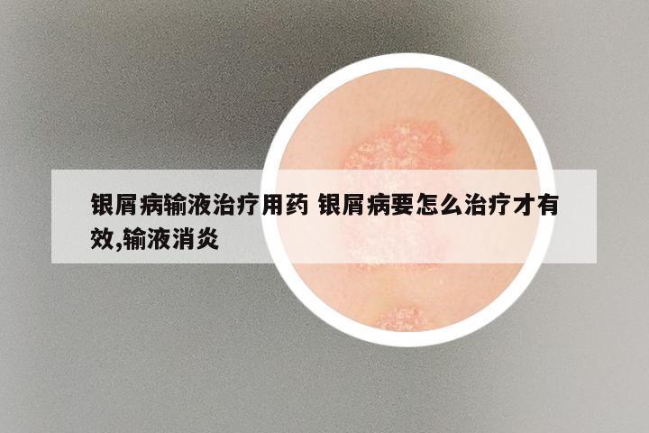 银屑病输液治疗用药 银屑病要怎么治疗才有效,输液消炎