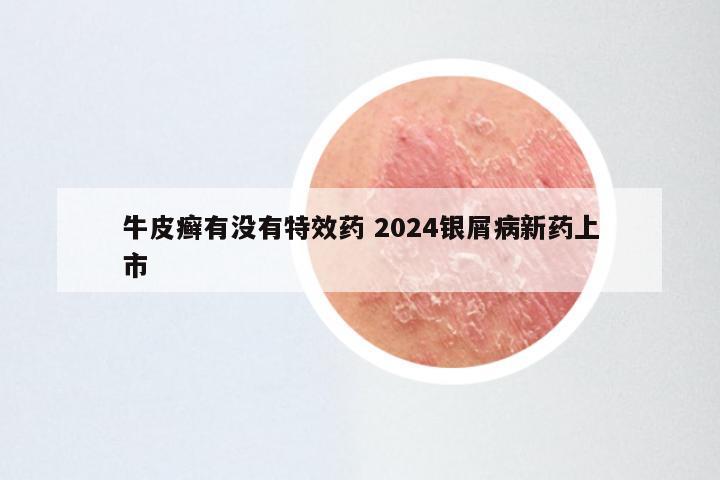 牛皮癣有没有特效药 2024银屑病新药上市