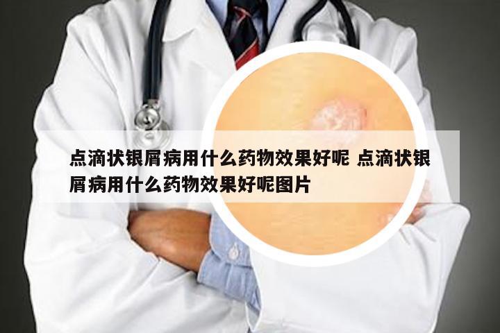 点滴状银屑病用什么药物效果好呢 点滴状银屑病用什么药物效果好呢图片