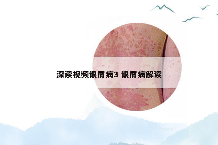 深读视频银屑病3 银屑病解读