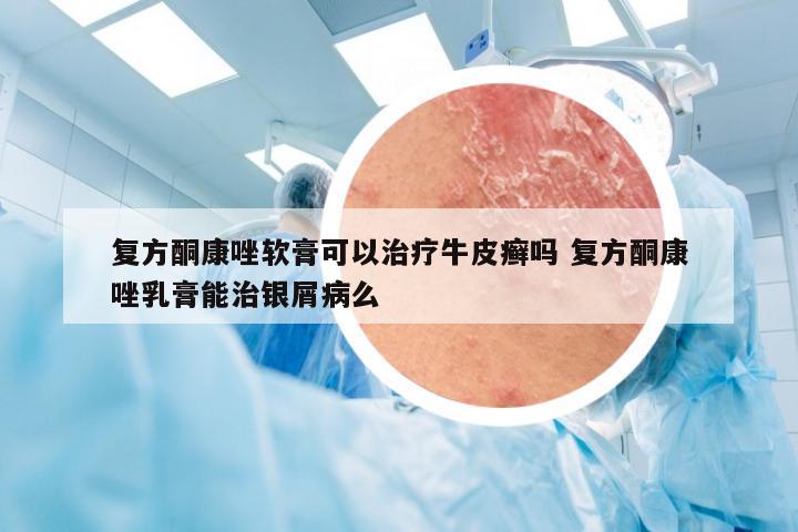 复方酮康唑软膏可以治疗牛皮癣吗 复方酮康唑乳膏能治银屑病么