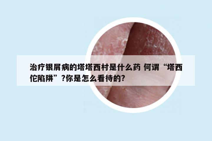 治疗银屑病的塔塔西村是什么药 何谓“塔西佗陷阱”?你是怎么看待的?