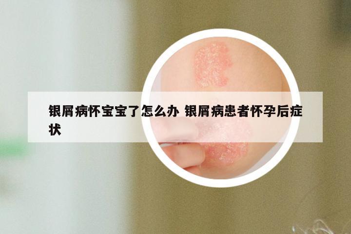 银屑病怀宝宝了怎么办 银屑病患者怀孕后症状