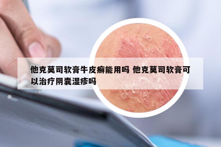 他克莫司软膏牛皮癣能用吗 他克莫司软膏可以治疗阴囊湿疹吗