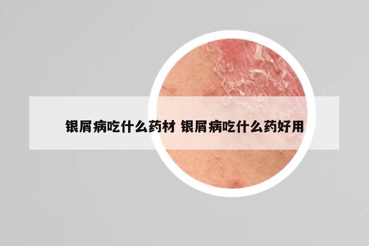 银屑病吃什么药材 银屑病吃什么药好用