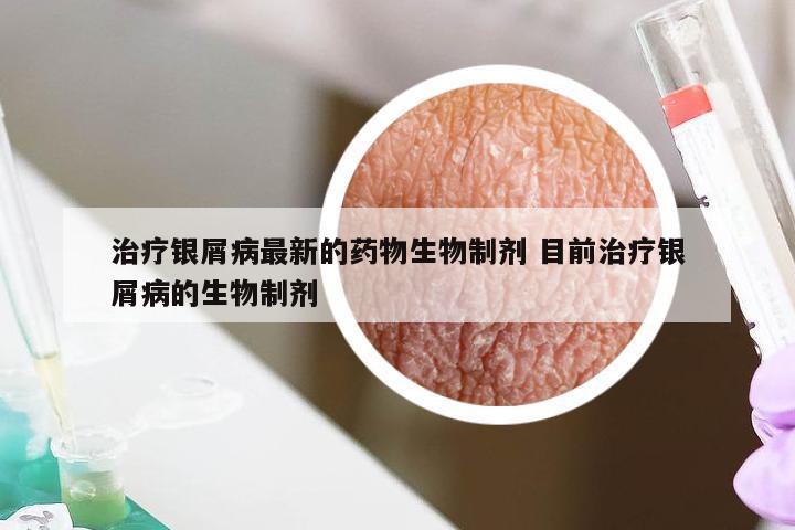 治疗银屑病最新的药物生物制剂 目前治疗银屑病的生物制剂