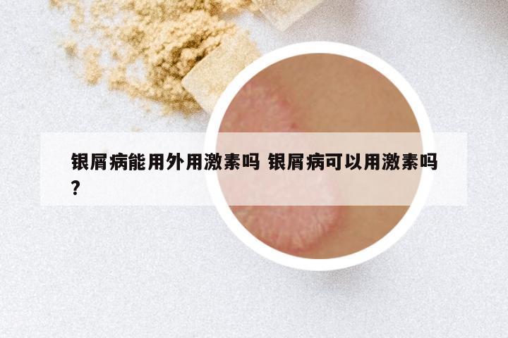 银屑病能用外用激素吗 银屑病可以用激素吗?