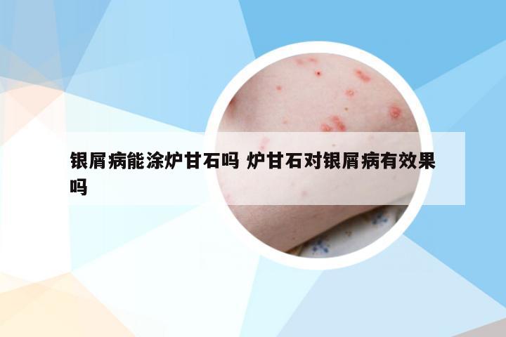 银屑病能涂炉甘石吗 炉甘石对银屑病有效果吗