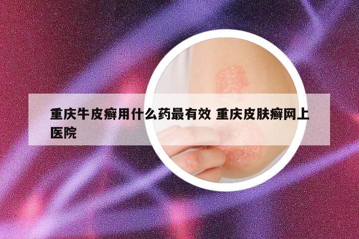 重庆牛皮癣用什么药最有效 重庆皮肤癣网上医院