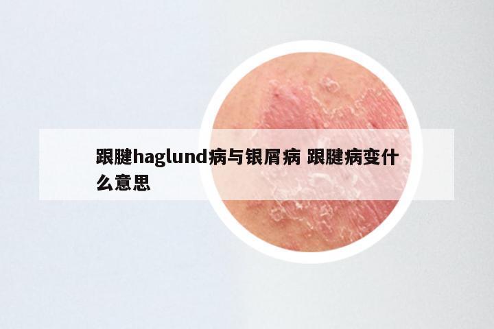 跟腱haglund病与银屑病 跟腱病变什么意思