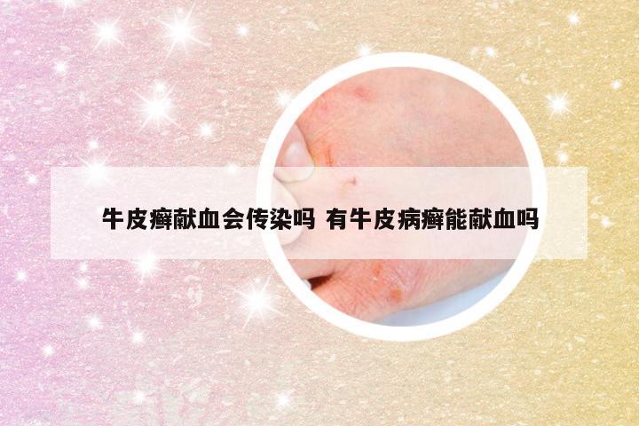 牛皮癣献血会传染吗 有牛皮病癣能献血吗