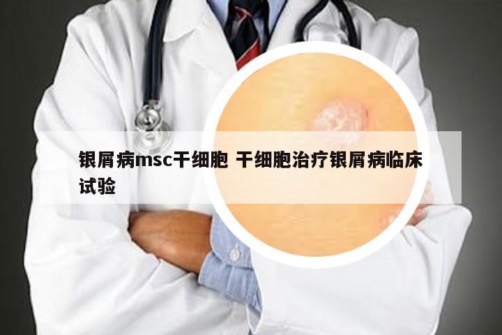 银屑病msc干细胞 干细胞治疗银屑病临床试验