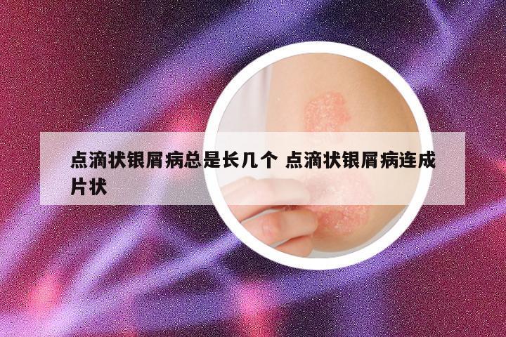 点滴状银屑病总是长几个 点滴状银屑病连成片状