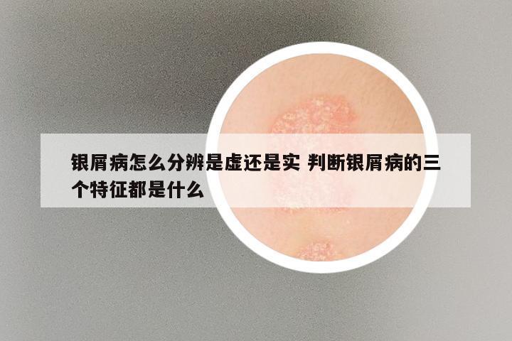 银屑病怎么分辨是虚还是实 判断银屑病的三个特征都是什么