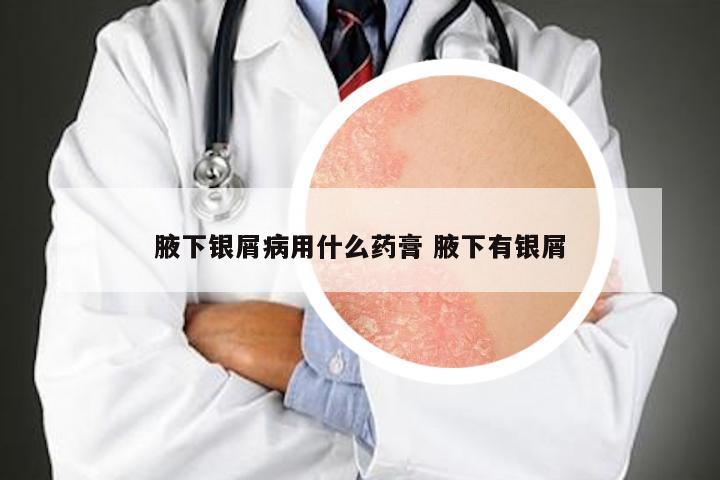 腋下银屑病用什么药膏 腋下有银屑