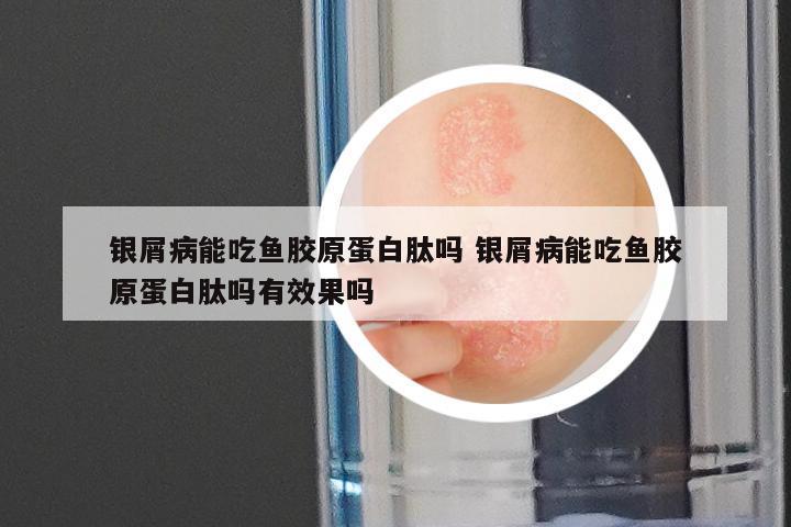 银屑病能吃鱼胶原蛋白肽吗 银屑病能吃鱼胶原蛋白肽吗有效果吗