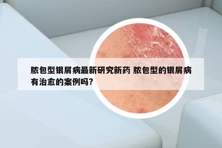 脓包型银屑病最新研究新药 脓包型的银屑病有治愈的案例吗?